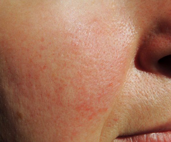 excel-v-and-rosacea-scaled