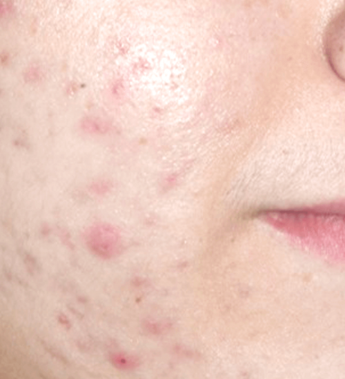 holcomb-pure-dermatology-acne
