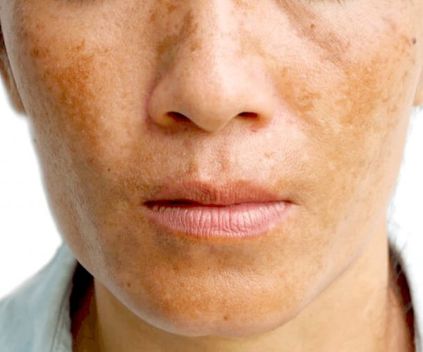 holcomb-pure-dermatology-melasma-sun-spots-1